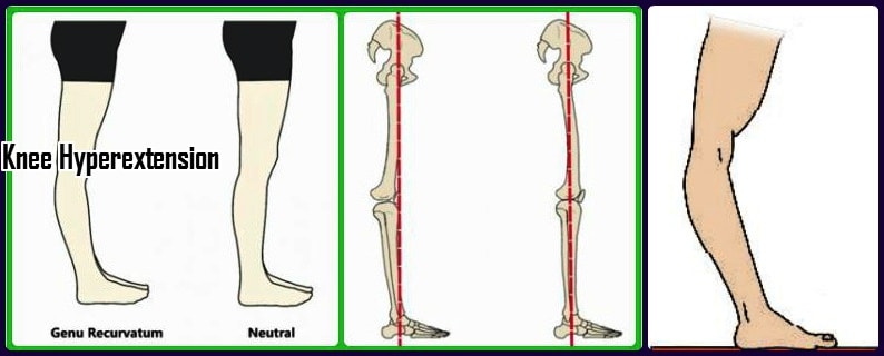 Genu recurvatum knee hyperextension