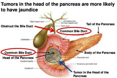 bile duct cancer image