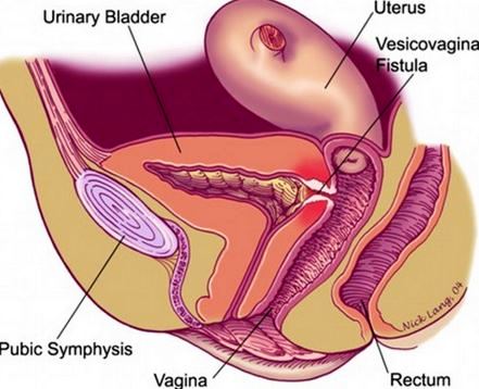 obstetric fistula image