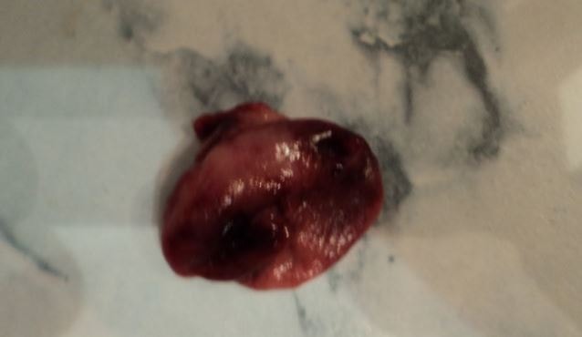 uterine decidual cast