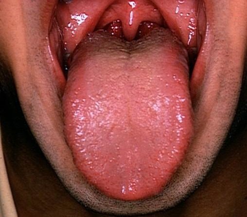 C:\Documents and Settings\TK\My Documents\enlarged-tonsils.jpg